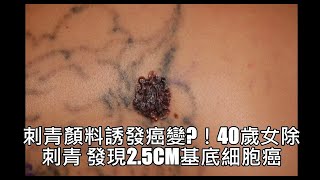 觀察者識讀/刺青顏料誘發癌變?！40歲女除刺青 發現2.5cm基底細胞癌