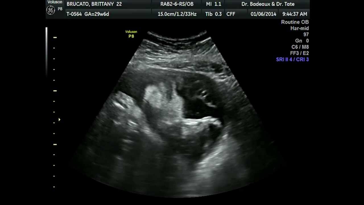 29 Weeks Pregnant 2d Ultrasound