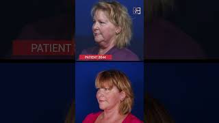 Extended Rhytidectomy Before and After (Patient 3044) #shorts