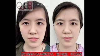 麒力整骨立体小颜矫正术 3D Face Make 脸型矫正缩小