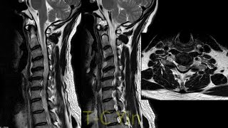 Biportal endoscopic cervical discectomy (C67, left side)