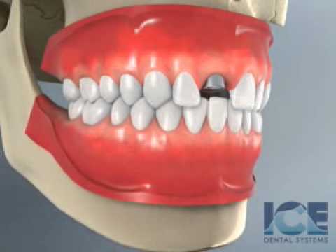 Dental Implants Youtube