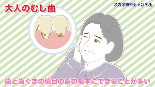 【高松市_健康_歯医者】なぜ気づかない？大人のむし歯_スガタ歯科チャンネル216（口腔ケアチャンネル）