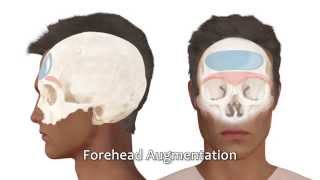 Male to Female (MTF) Facial Feminization Surgery