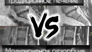 Традиционное лечение VS Модулируемая резорбция.