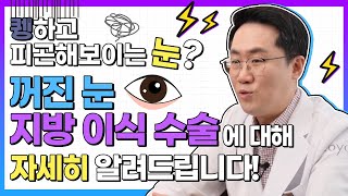 [성형정보] 퀭하고 피곤해 보이는 눈?😳 꺼진 눈 지방이식 수술에 대해 자세히 알아보자구!!  ｜#꺼진눈지방이식 #눈꺼풀지방이식