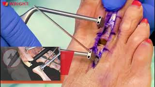 GRAVITY™ Plantar Plate Repair System surgical highlights and tips and tricks with Dr. James Sferra