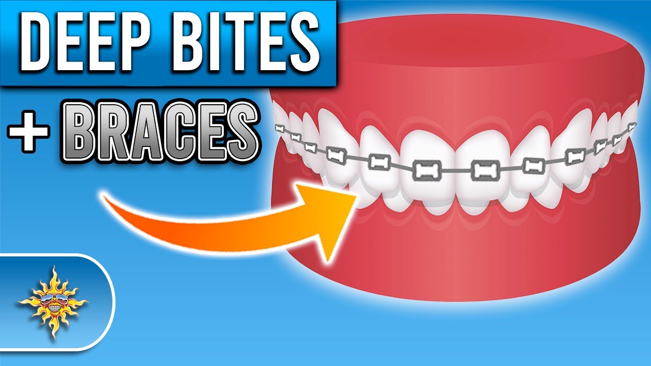 How Do Braces Fix Deep Bites? | Premier Orthodontics - YouTube