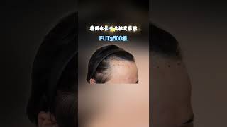 韓國永長植髮切開式3500根效果🤟 #韓國植髮醫院推薦 #hairtransplantsurgery #永長植髮 #hairtransformation #韓國切開式植髮#fut植髮 #FUR植髮