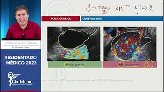 Ginecología - 14 Masa ovárica benigna