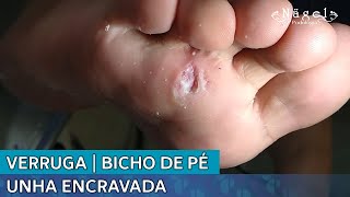 VERRUGA | BICHO DE PÉ | UNHA ENCRAVADA