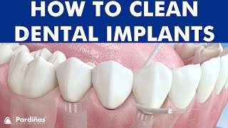 Dental floss and waterpik - How to clean dental implants ©
