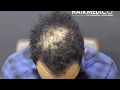 FUE Hair Transplant / Sapphire Technique of Implantation / Dr Arslan Musbeh