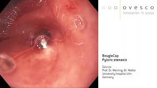 BougieCap | Pyloric stenosis