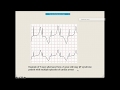 Sudden cardiac death and Latest updates about it. #scd #suddencardiacdeath #cardiacarrest #ARVC