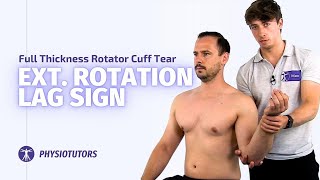 External Rotation Lag Sign | Full Thickness Rotator Cuff Tears