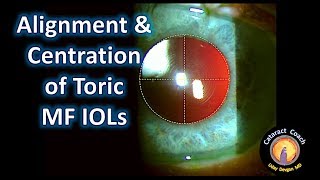 Alignment and Centration of Toric Multi-Focal IOLs in Cataract Surgery