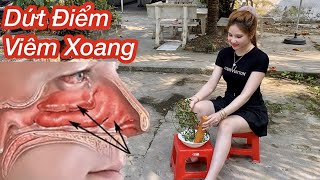 2 Cách Trị Hết Viêm Xoang Cấp Tóc Siêu Nhanh \\100% Dứt Điểm Viêm Xoang Với Loại Cây Cỏ Này