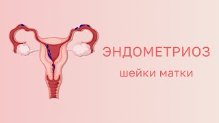 🧐 Эндометриоз шейки матки: диагностика и лечение