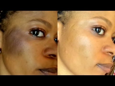 HOW TO HEAL OR CURE SUNBURN NATUALLY |AT HOME |FAST RESULT HOW TO HEAL OR CURE SUNBURN NATUALLY |AT HOME |FAST RESULT