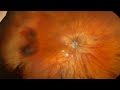 2024 08 Peripheral Exudative Hemorrhagic Chorioretinopathy PECHR   Heidi Mina