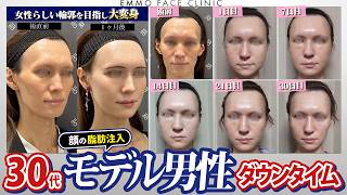 【過去イチの変化】30代後半モデル、女性らしい輪郭になりたい！脂肪注入で大変身！【ダウンタイム30日記録】