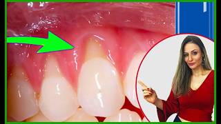 🟢Gingival Retraction how to end DEFINITIVE!! Home Recipe or Surgery?!