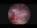 11 minute vats right lower lobe lobectomy nonedited