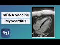 COVID-19 vaccine related myocarditis: explained