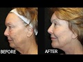 Combining Facial Procedures | Janiga MDs