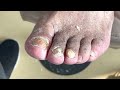 pull out thick onychomycosis with pliers infected the whole foot【pedicure master lin jun】