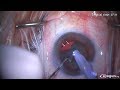 Anterior capsular tear during horizontal chop in cataract surgery