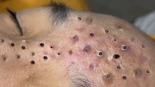 Loan Nguyen Acne Treatment 50x