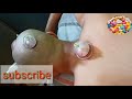 Cupping Therapy कैसे करते हैं||Hijama therapy Kaise Hoti hai||GN Medical Channel