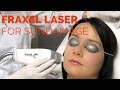 Fraxel Fractional laser resurfacing