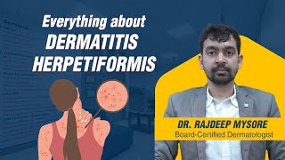 Everything about Dermatitis Herpetiformis - Dr. Rajdeep Mysore | Charma Clinic