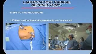 LAPAROSCOPIC RADICAL NEPHRECTOMY- PROCEDURE OVERVIEW