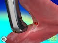 How tongue tie laser works