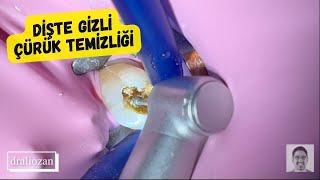 Diş Ağrısı Nasıl Geçer? | (Çok derin diş çürüğüne dolgu uygulanması)