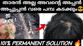 How to Get Rid of Dandruff | താരൻ പോകാൻ ഈ ഒരു കാര്യം മാത്രം 101%ഗ്യാരന്റി ❤️❤️#dandruff malayalam