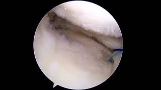 Arthroscopic All-Inside Medial Meniscus Extrusion Reduction