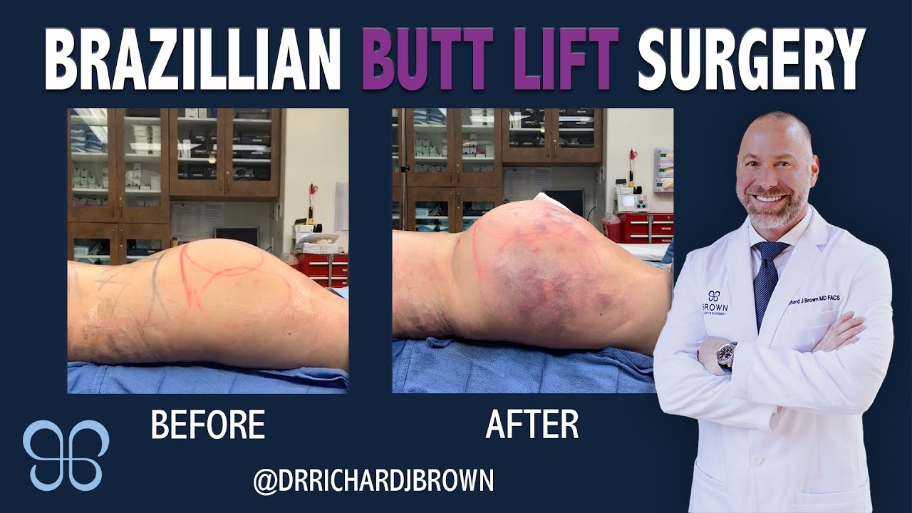 Brazilian Butt Lift Surgery And Pre-Op Example | Brown Plastic Surgery ...