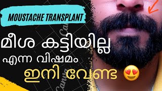 മീശക്കു കട്ടി ഇല്ല എന്ന വിഷമം ഇനി വേണ്ട 😍 Moustache Transplant ചെയ്തപ്പോൾ😎 #drsreenath #hairodent