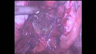 Resection of rectovaginal endometriosis done by Dr Nikita Trehan at Sunrise Hospital, New Delhi