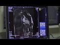 cardiac mri acquisition part 2