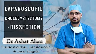Laparoscopic Cholecystectomy | Best Gallbladder Surgery in Kolkata | Best Laparoscopic Surgeon