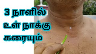 உள்நாக்கு வளர்ச்சி 3 நாட்களில் முழுவதும் கரைந்து விடும்| Sirunaaku karaiya remedy in tamil