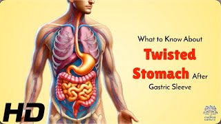 Twisted Stomach After Gastric Surgery: What You MUST Know!