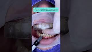 วีเนียร์แบบฉีด #softandsmiledentalclinic #วีเนียร์ #วีเนียร์แบบฉีด #หมอชิ #หมอเบล#ทําฟัน