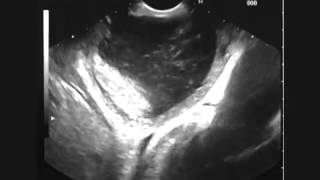 Upper Gastrointestinal Endoscopy and Endoscopic Ultrasonography